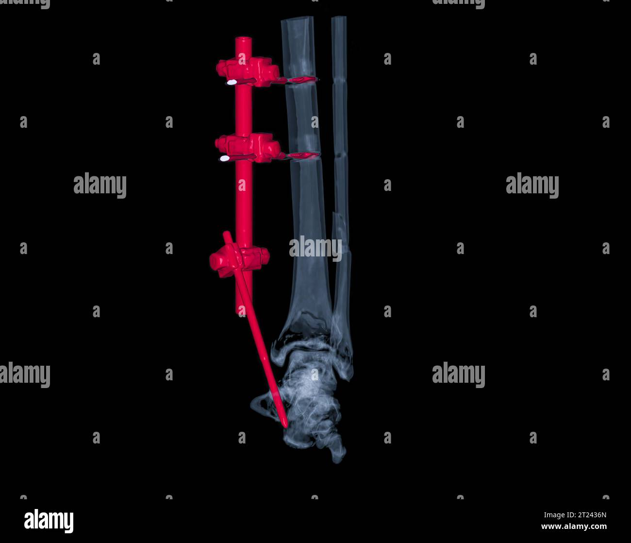 CT Scan 3D-Rendering-Bild mit Frakturen an Tibia und Fibula mit Platte ...