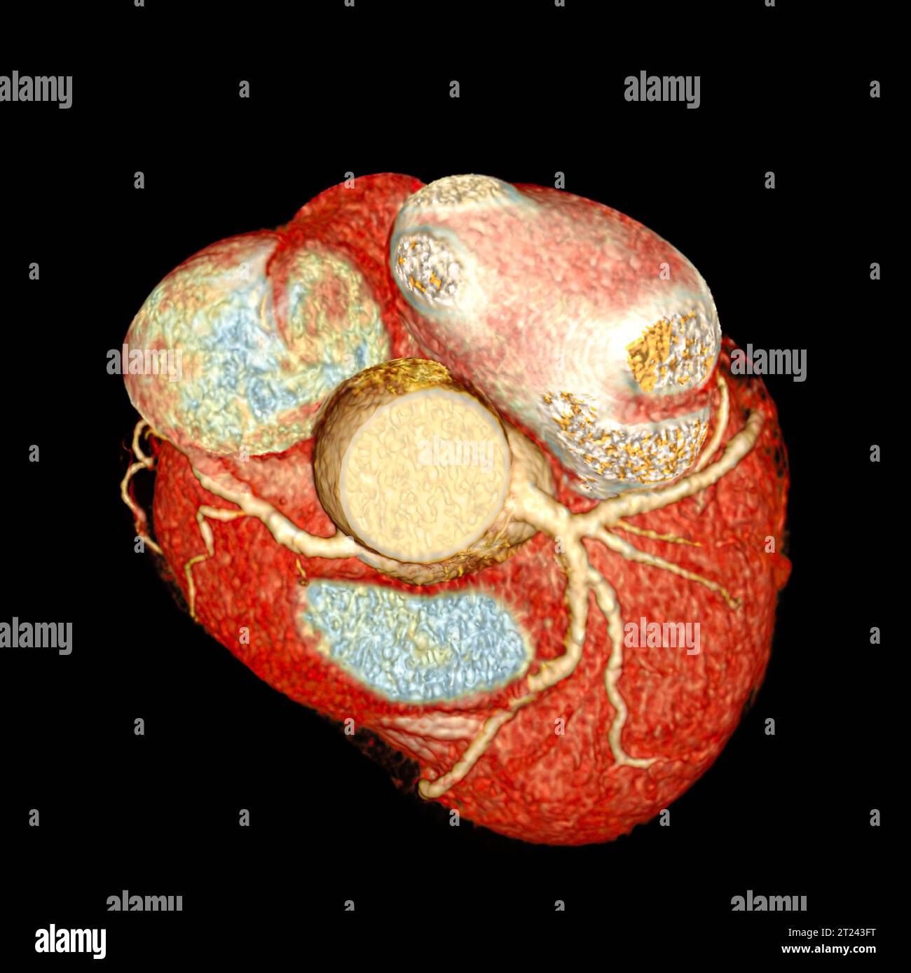 3D-Renderbild der CTA-Koronararterie. CT-Angiographie bei Herzerkrankungen. Stockfoto