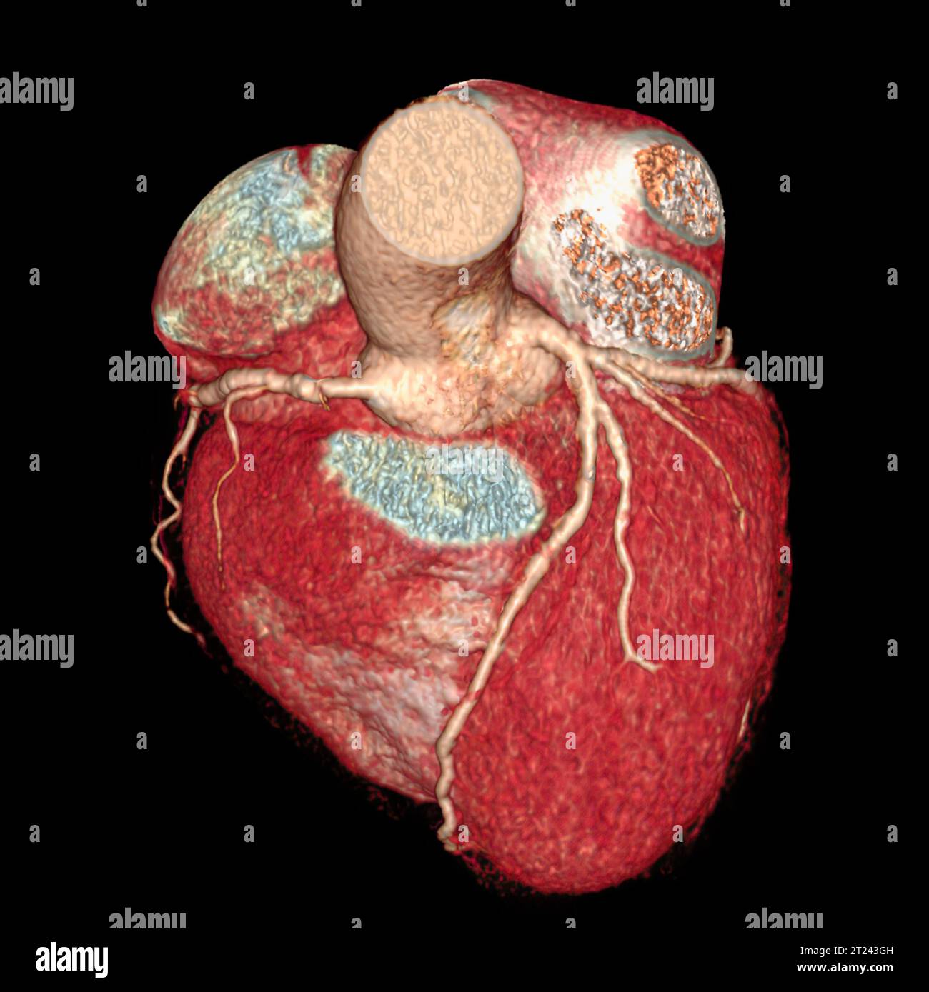 3D-Renderbild der CTA-Koronararterie. CT-Angiographie bei Herzerkrankungen. Stockfoto