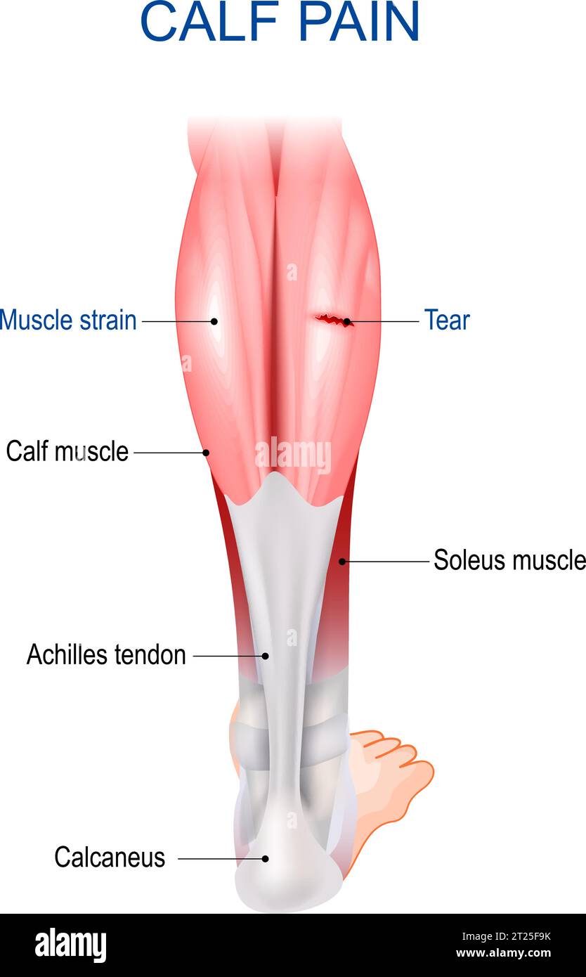 Wadenschmerzen. Zur Anatomie der Wadenmuskulatur. Die Muskelstruktur einer menschlichen Lerg. Medizinische Infografik. Vektorabbildung Stock Vektor
