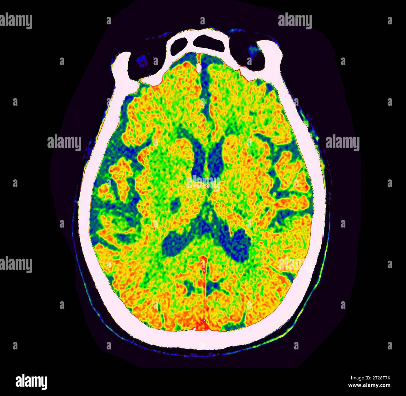 Fall Axially CT Brain Perfusion oder CT-Scan der axialen Ansicht des Gehirns, die ...