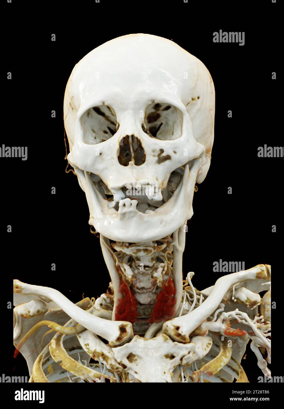 CTA Gehirn und Arteria carotis oder CT-Angiographie des Gehirns 3D-Rendering-Bild. Stockfoto