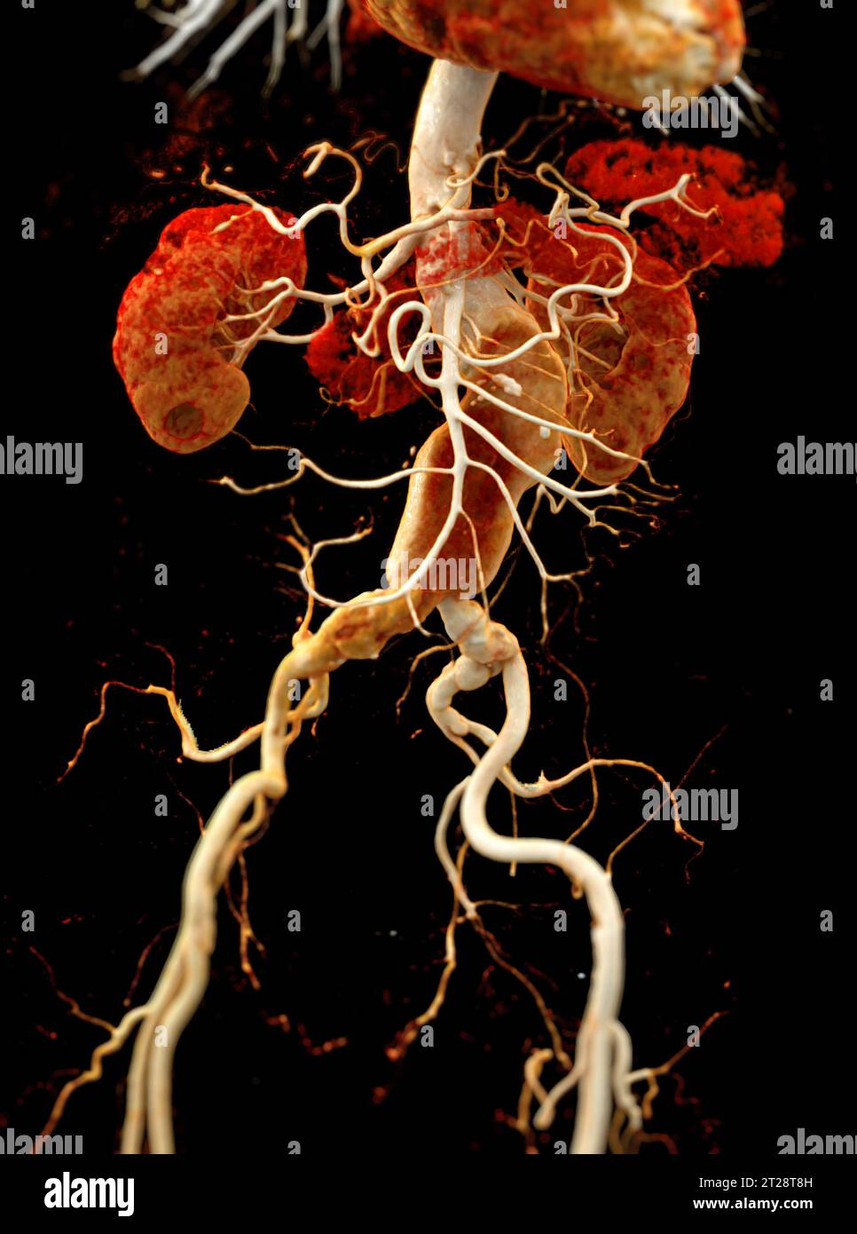 CTA Aorta abdominalis mit 3D-Rendering der abdominalen Aortendissektion. Stockfoto