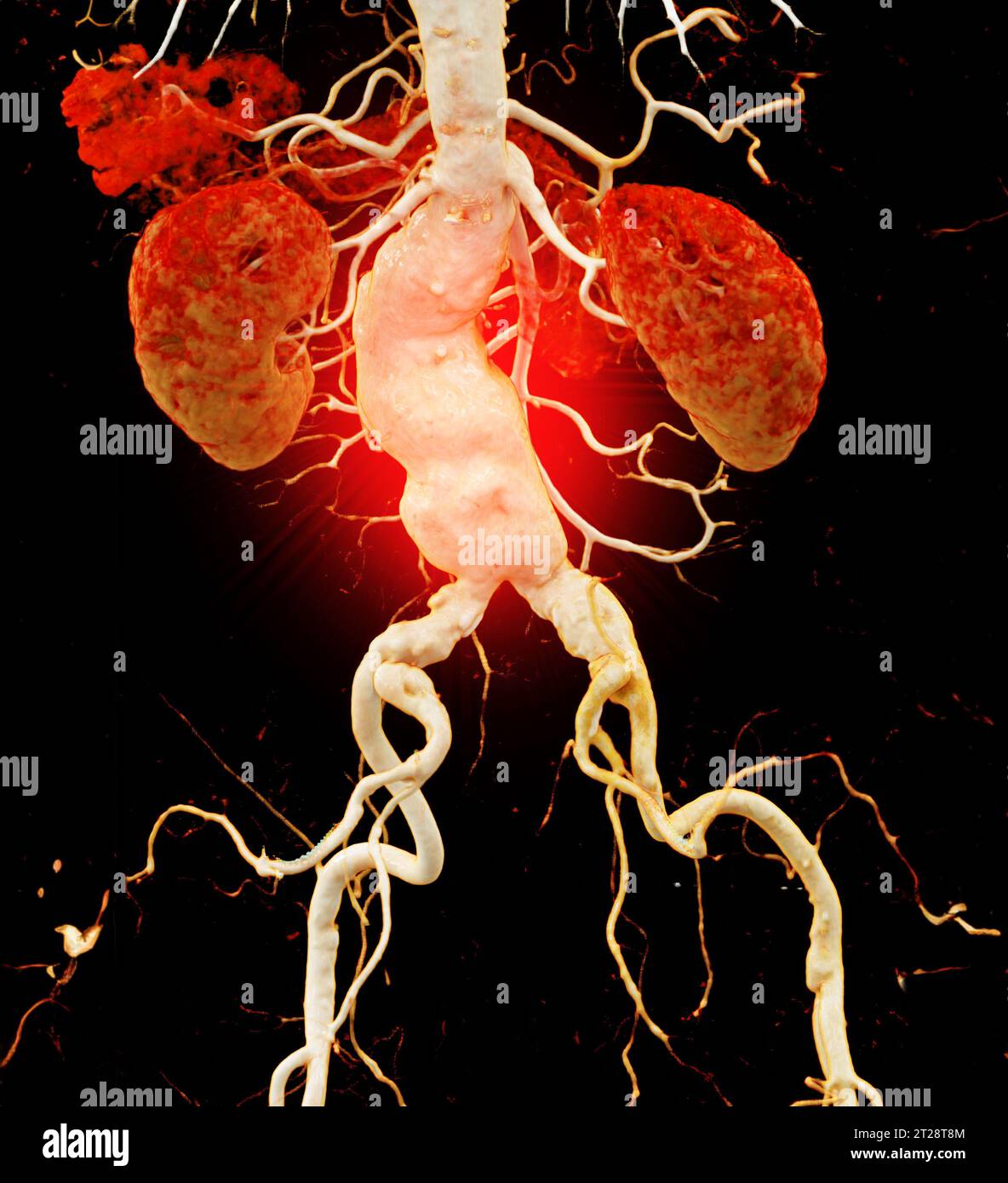 CTA Aorta abdominalis mit 3D-Rendering der abdominalen Aortendissektion. Stockfoto