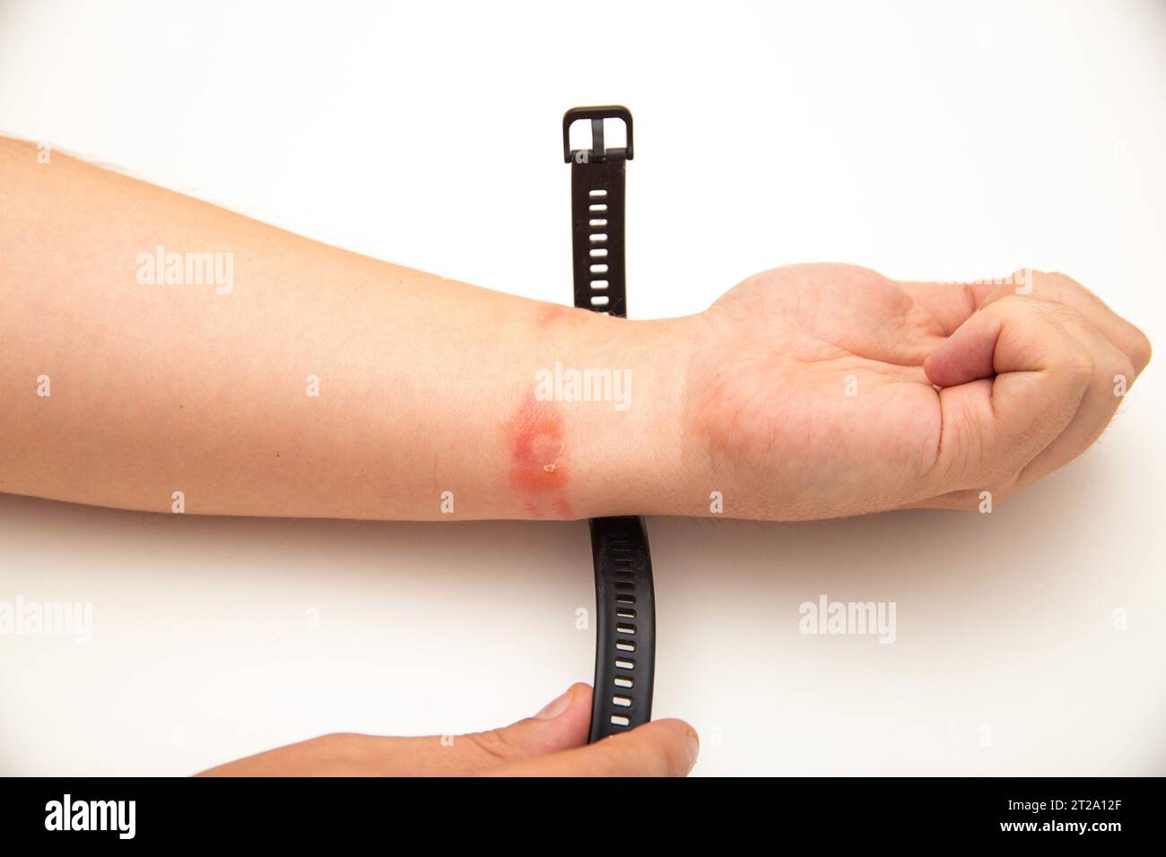 Rötungen und Allergien am Handgelenk einer Person durch das Tragen eines Fitnessarmbands mit Silikonband. Kontaktdermatitis Stockfoto