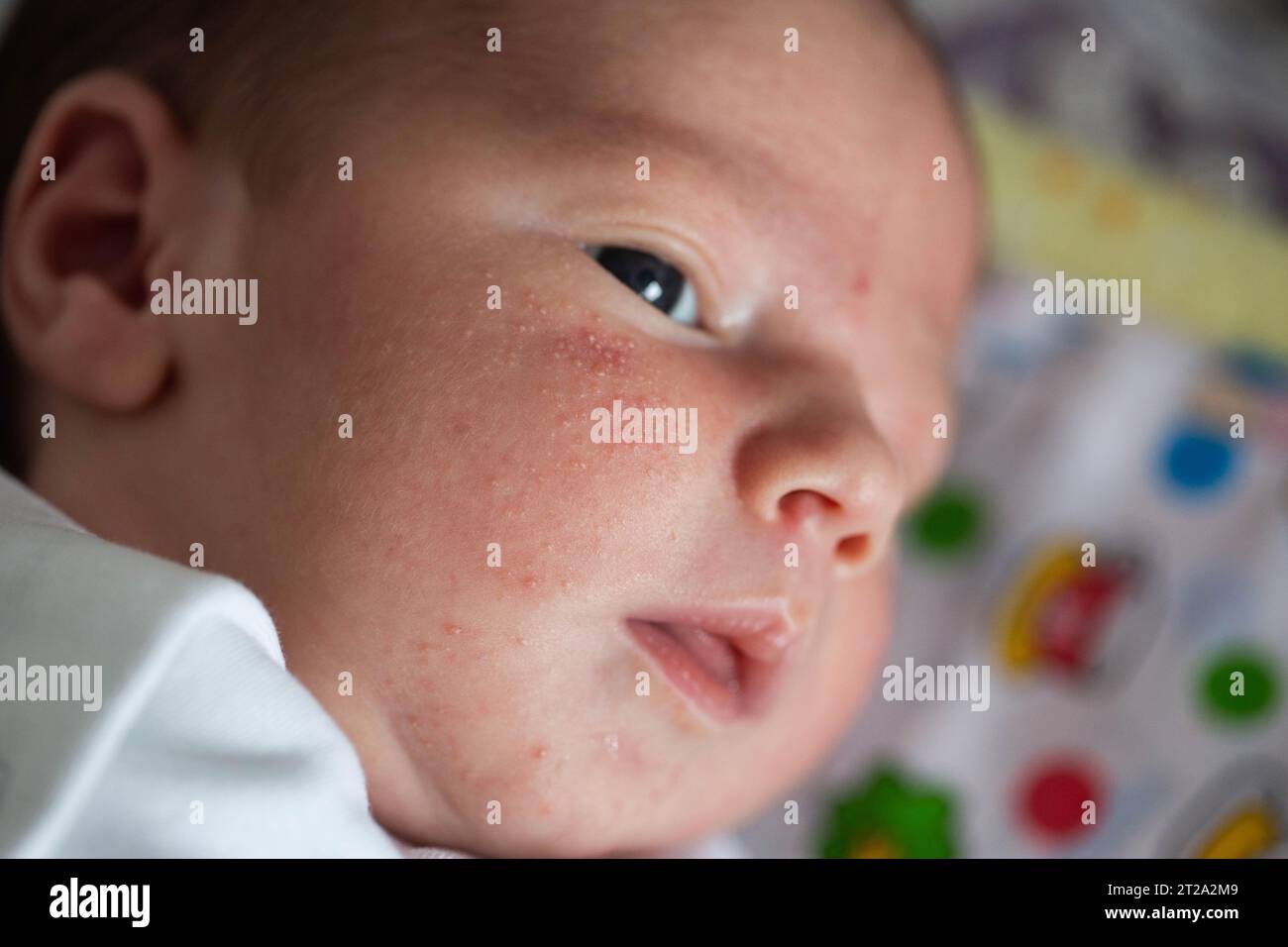 Ausschlag im Gesicht eines Neugeborenen. Der Entstehungsvorgang des Hormonsystems. Stockfoto