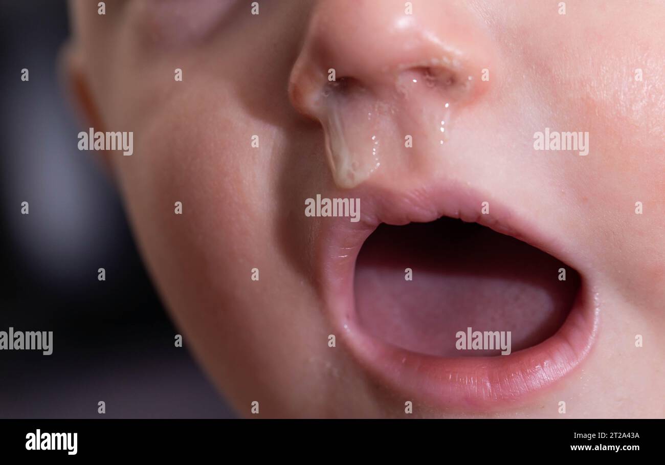 Gelber Rotz aus der Nase eines Kindes, Nahaufnahme. Sinusinfektionen, Erkältungen und Viren. Chronische laufende Nase Stockfoto