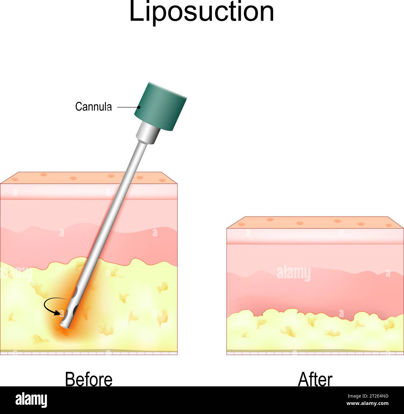 Das Liposuktionsverfahren. Vorher und nachher. Fettentfernung und Kosmetische Chirurgie. Fettabsaugung zur Gewichtsabnahme. Vektorabbildung Stock Vektor