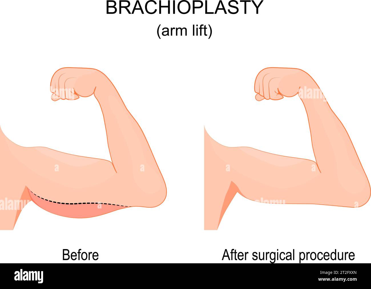 Brachioplastik. Vor und nach chirurgischen Eingriffen. Heben des Arms. Vorderansicht. Kosmetische Chirurgie. Vektorabbildung Stock Vektor