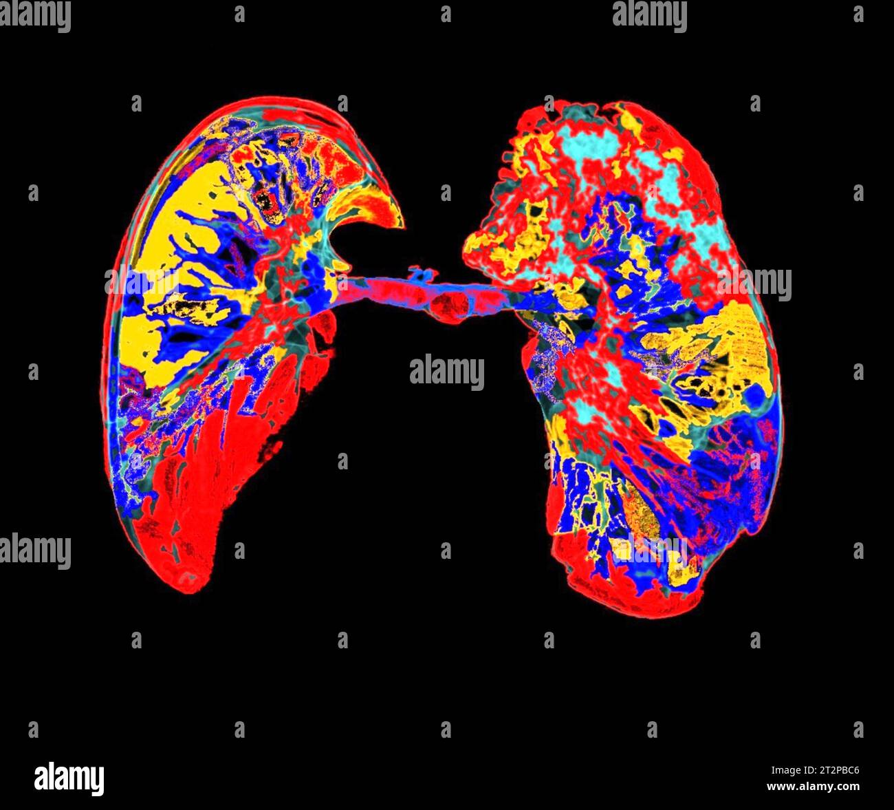 Gesunde Lunge, CT-Scan Stockfoto