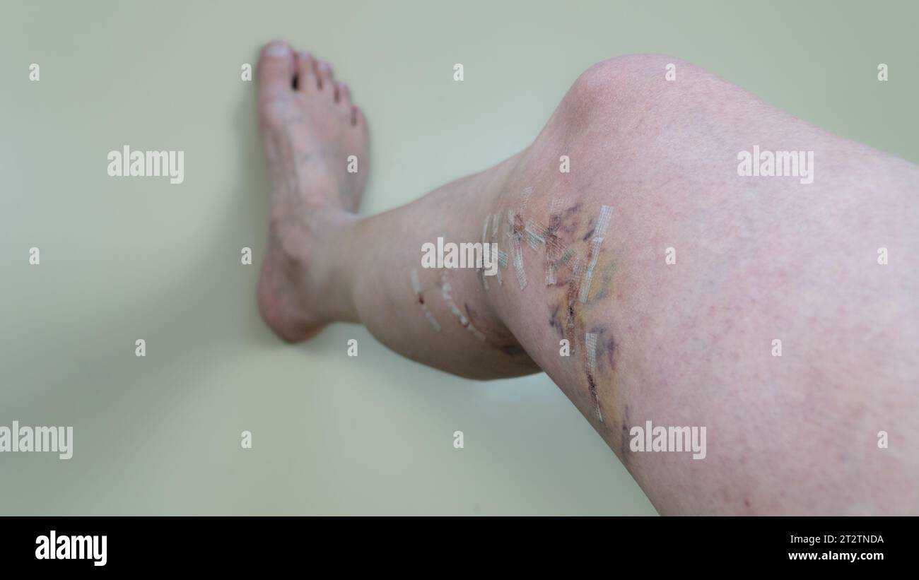 Eine visuelle Darstellung des Heilungsprozesses nach einer Venenoperation, die das Erscheinungsbild und die Entwicklung von Narben und Blutergüssen des Mannes beleuchtet Stockfoto