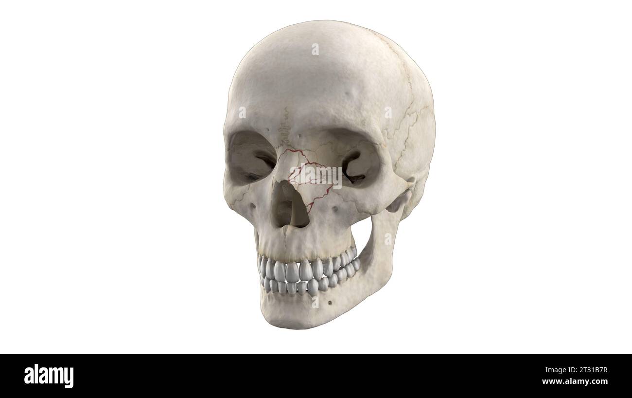 3D-medizinische Darstellung der Schädelnasenfraktur am menschlichen Skelett Stockfoto