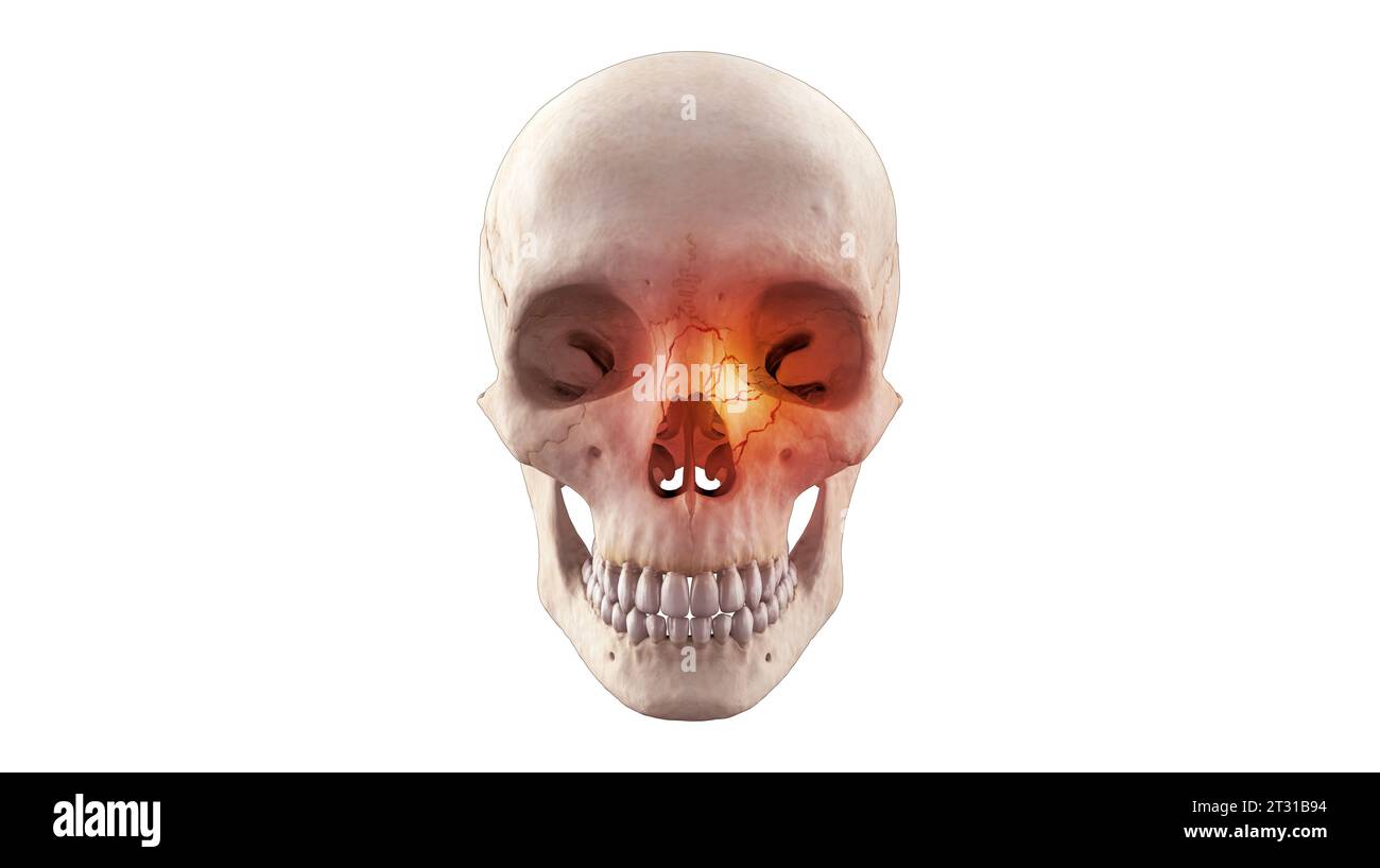 3D-medizinische Darstellung der Schädelnasenfraktur am menschlichen Skelett Stockfoto