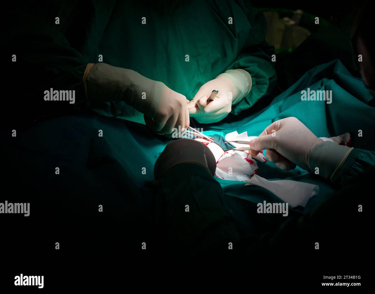 Nahaufnahme der Hände eines Chirurgen, die den Hautschnitt eines Patienten nähten. Stockfoto