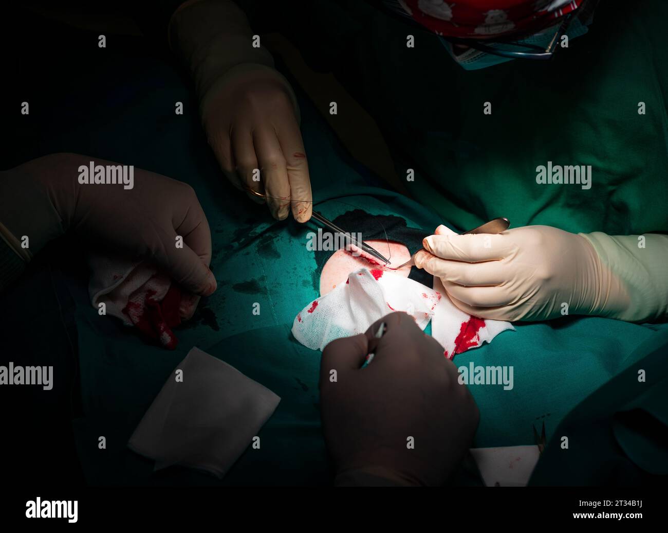 Nahaufnahme der Hände eines Chirurgen, die den Hautschnitt eines Patienten nähten. Stockfoto