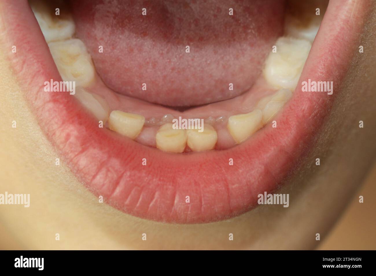 Die bleibenden Zähne eines Kindes wachsen neben den Zähnen des Babys, die nicht herausgefallen sind. Zweite Zahnreihe. Zahnheilkunde. Ein medizinisches Konzept. Zahnwechsel. Schließen Stockfoto