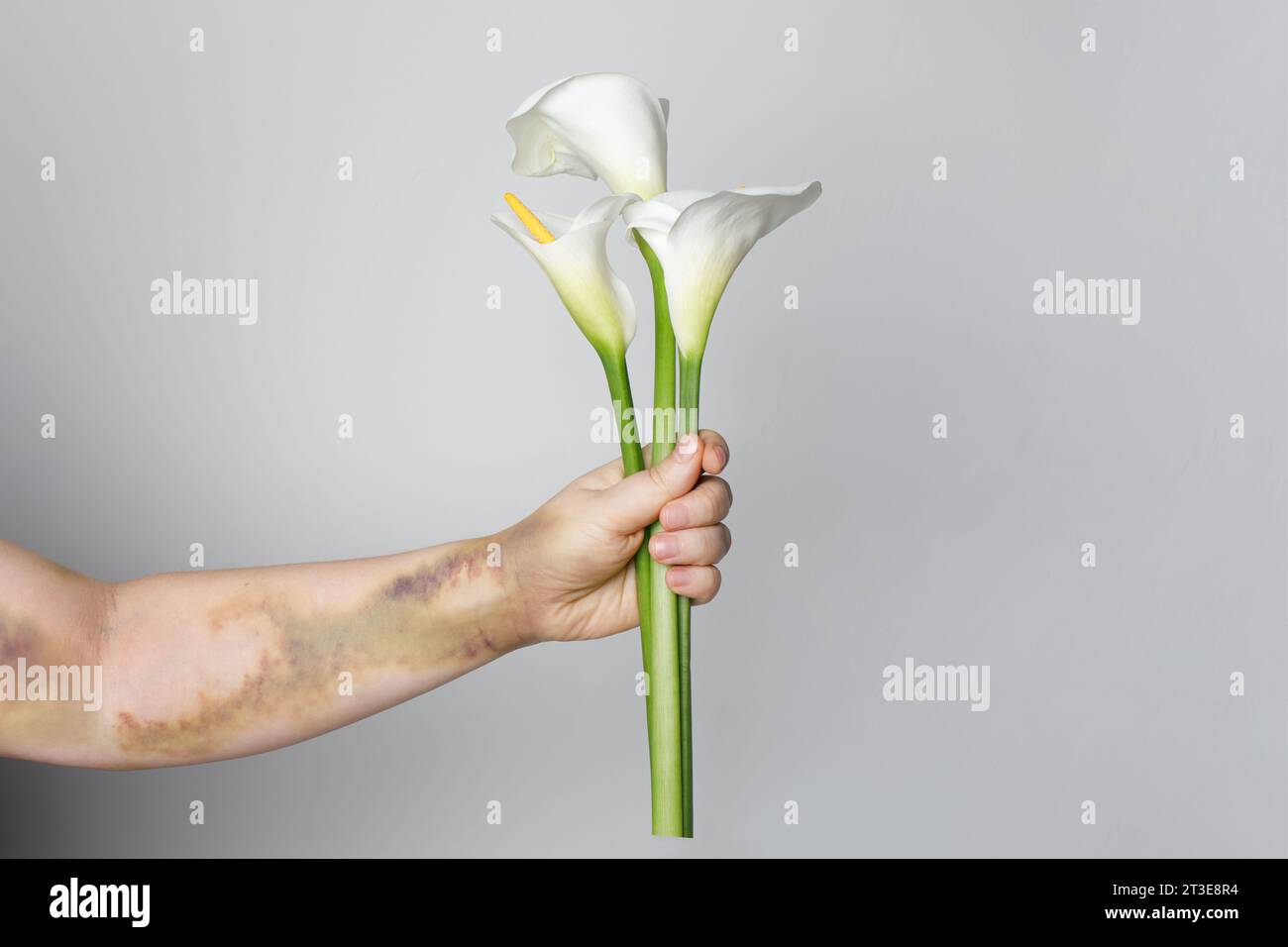 Medizin und Behandlung. Weibliche Hand nach Lungenembolie-Operation Nahaufnahme Stockfoto