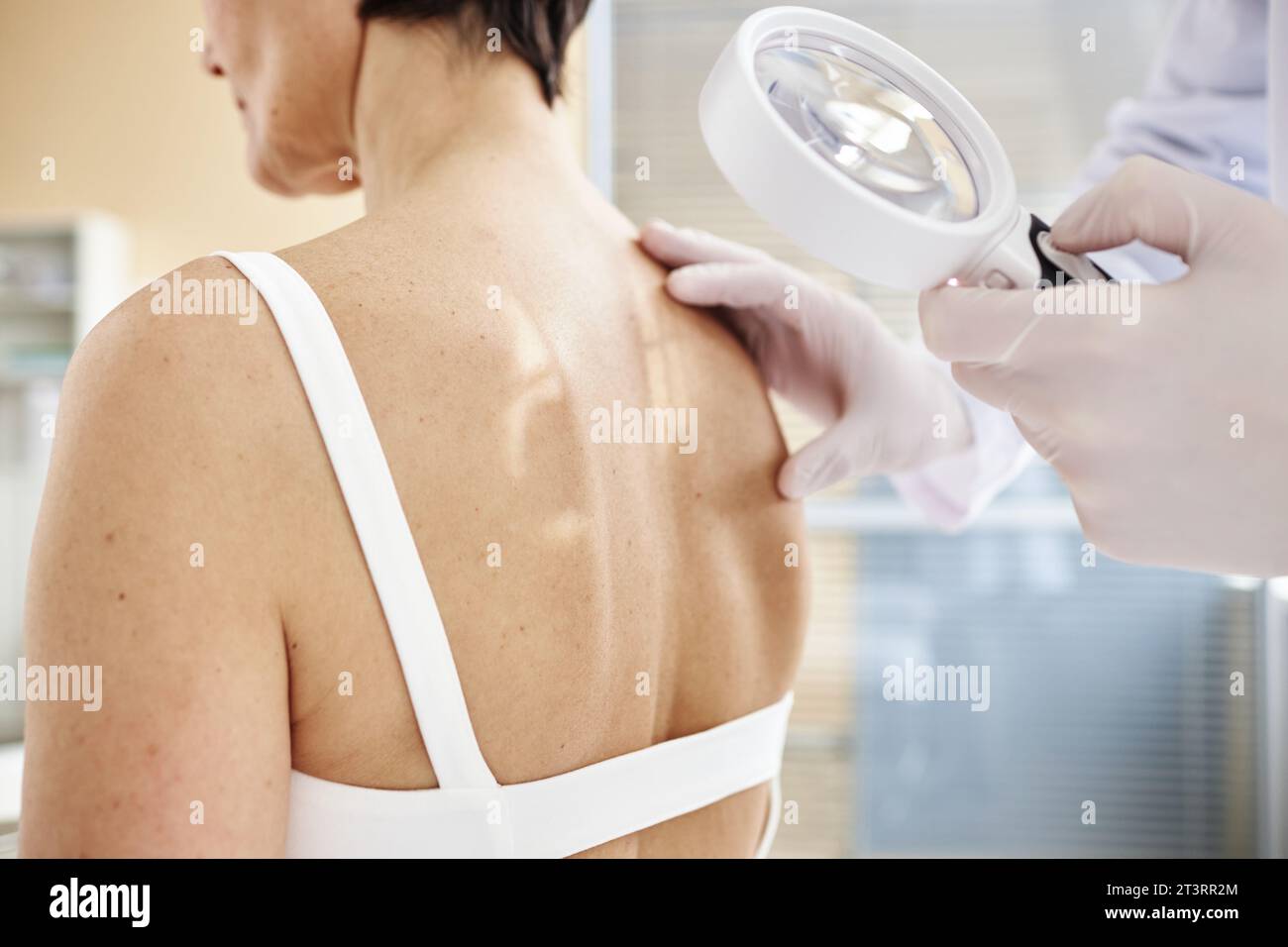 Nahaufnahme eines Arztes, der Lupe hält, während er die Rückseite der Patientin in der Dermatologie untersucht, Kopierraum Stockfoto