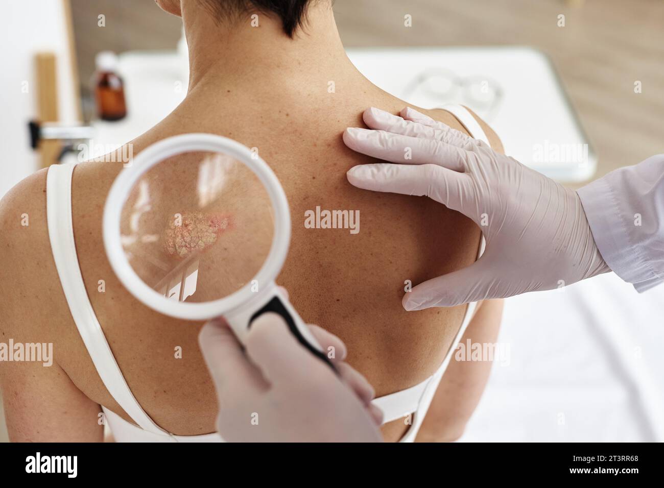 Nahaufnahme eines Arztes mit Lupe bei Untersuchung des Rückens einer Patientin mit Hautausschlag in der Dermatologischen Klinik, Kopierraum Stockfoto