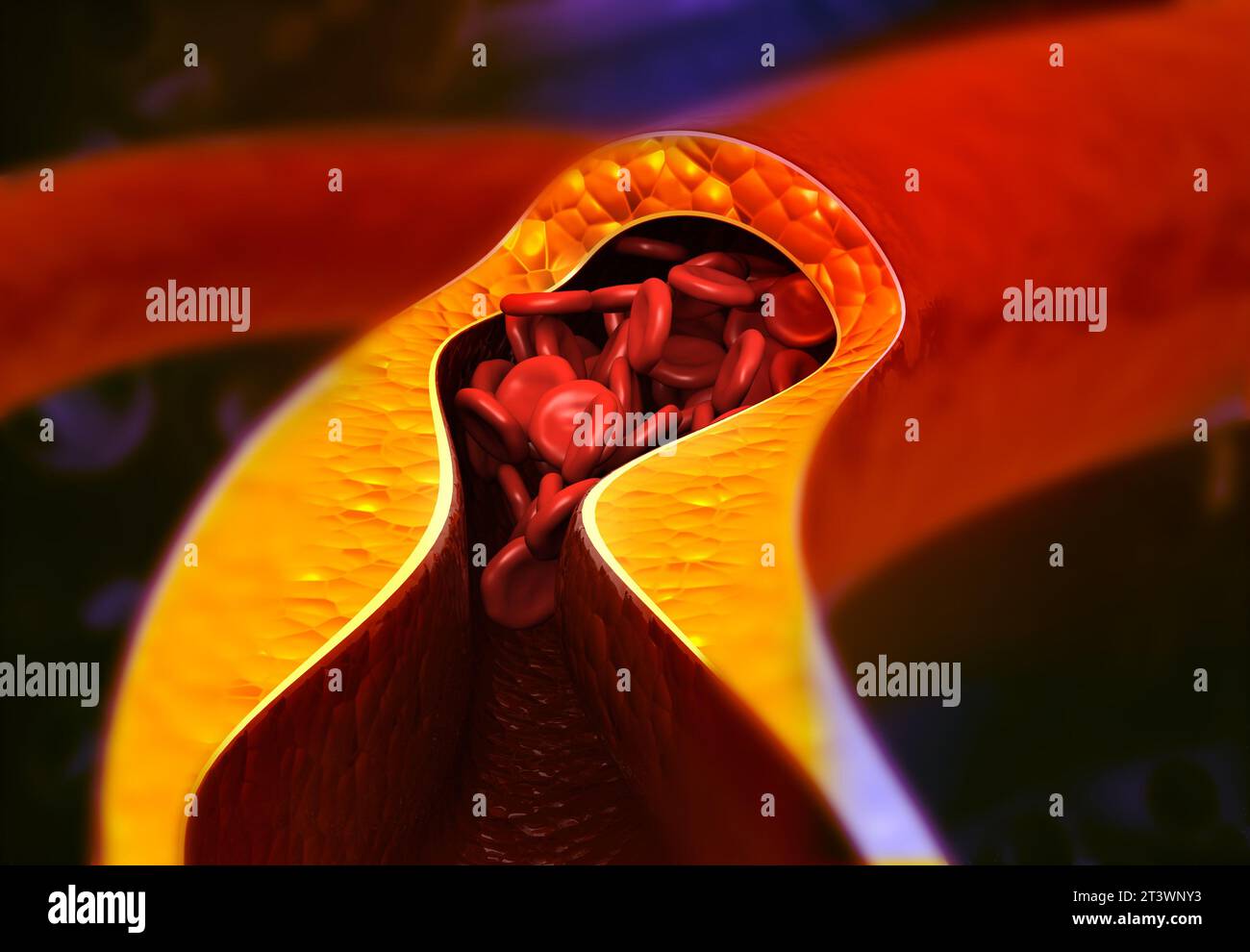 Arterie mit schlechtem Cholesterin blockiert. Verstopfte Arterien Koronararterienplaque. 3D-Rendering Stockfoto