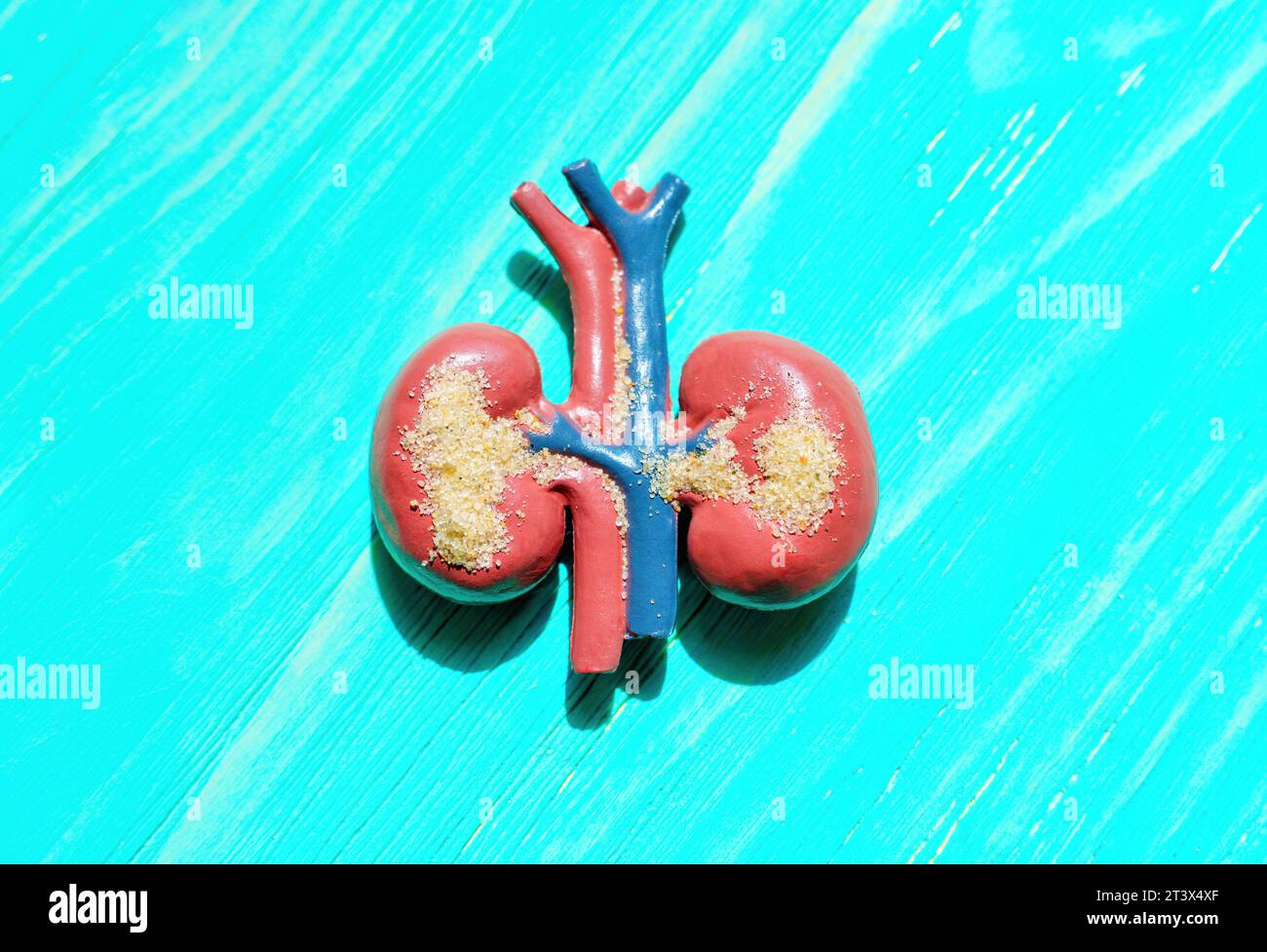 Anatomisches Modell, das menschliche Nieren mit sandähnlichen Partikeln darstellt, symbolisiert die Gesundheit der Niere und potenzielle Probleme. Stockfoto
