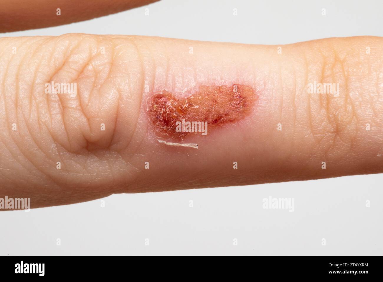 Weibliche Hand mit Schorf aufgrund von Impetigo, einer ansteckenden bakteriellen Infektion, die Hautläsionen verursacht, die durch Staphylococcus aureus und Streptococcus p Stockfoto