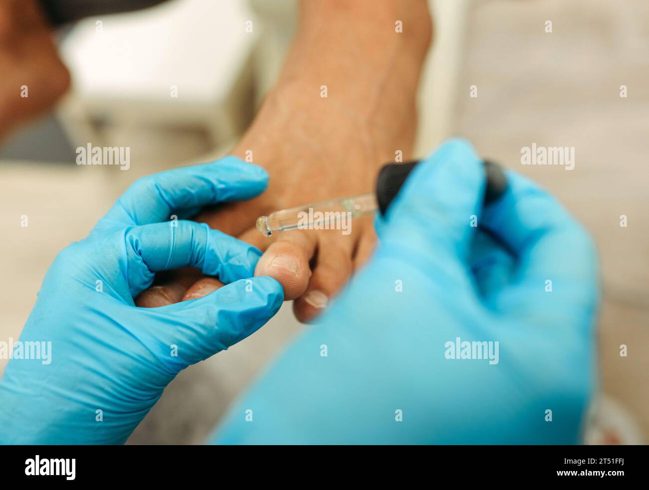 Ein Arzt lässt das Arzneimittel aus einer Pipette auf einen schmerzenden Finger fallen