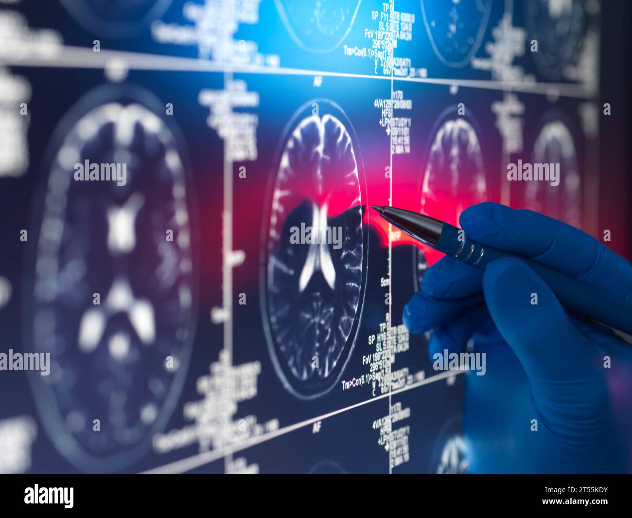 Arzt sieht einen Gehirnscan des Patienten auf dem Bildschirm an Stockfoto