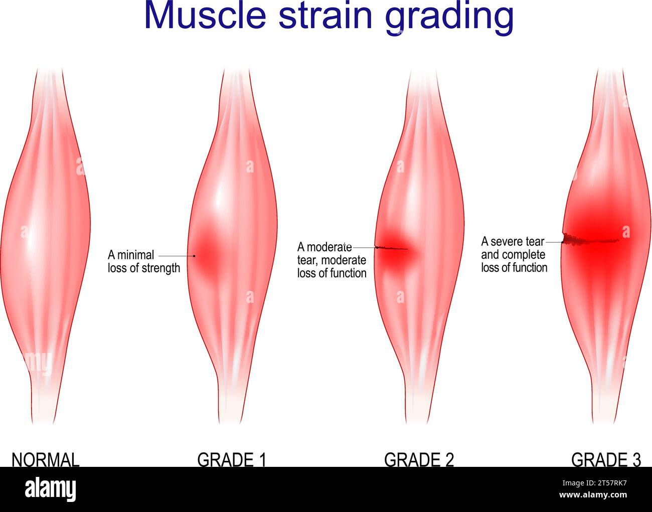 Muskel-Strain-Grading. Grad 1 ist Ein minimaler Kraftverlust. Grad 3 ist ein schwerer Riss und vollständiger Funktionsverlust. Vektorabbildung Stock Vektor
