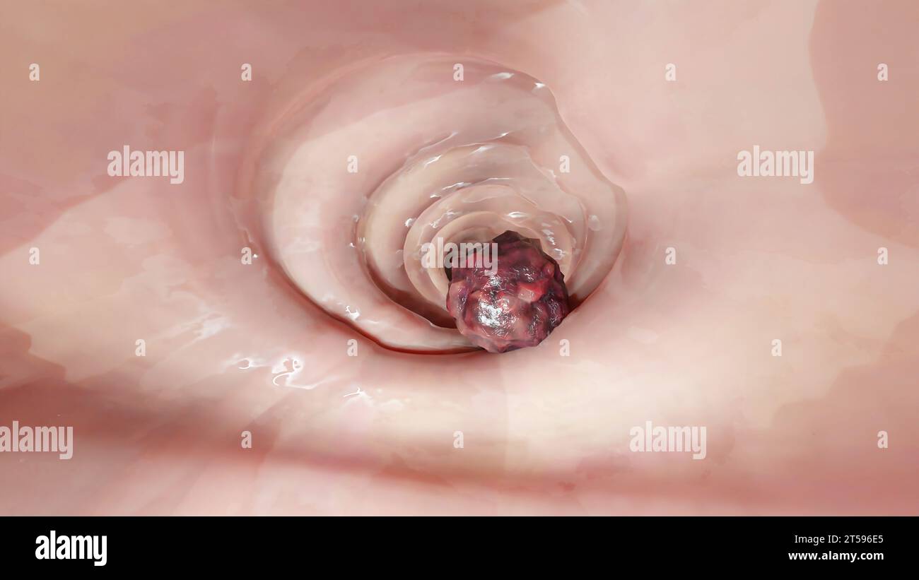 Darmkrebs, bösartiger Tumor im Darm, Endoskop im Inneren der Kolonoskopie, Darmdarm, Entfernung von Kolonpolypen, Suche nach Kolonpolypen, Polypektomie, Stockfoto