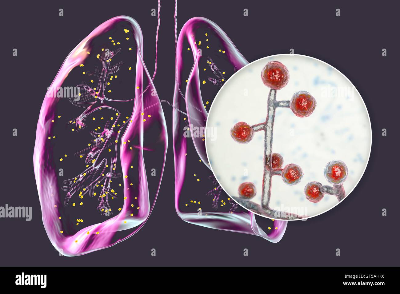 Lungenadiaspiromykose, Illustration Stockfoto