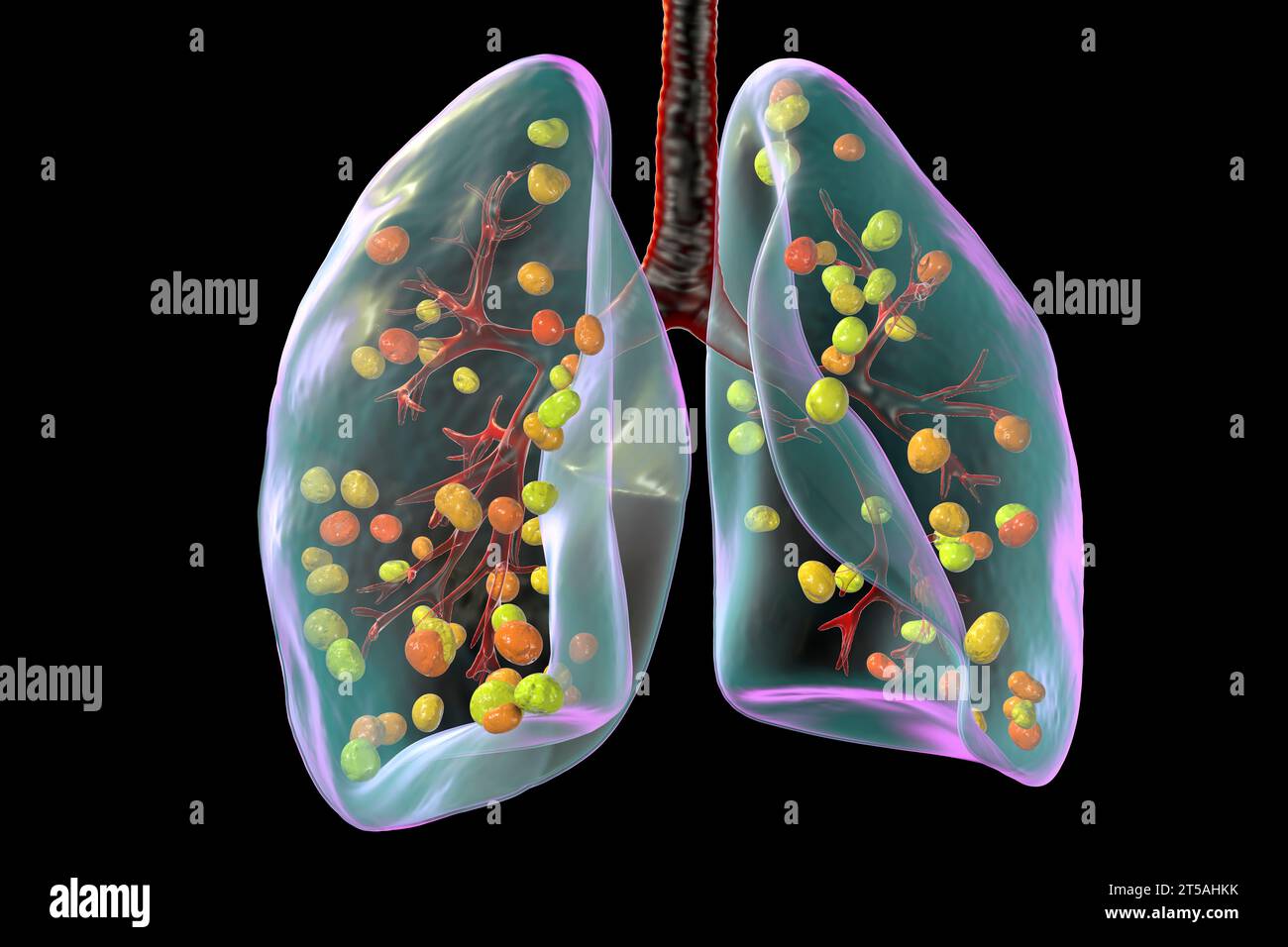 Lungenhistoplasmose, Illustration Stockfoto
