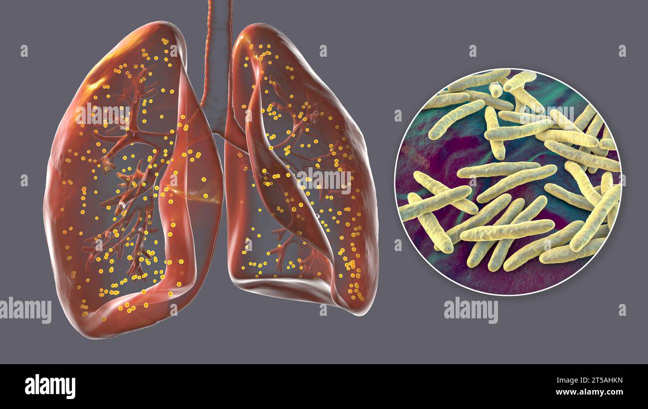 Lungen mit Miliartuberkulose, Illustration Stockfoto