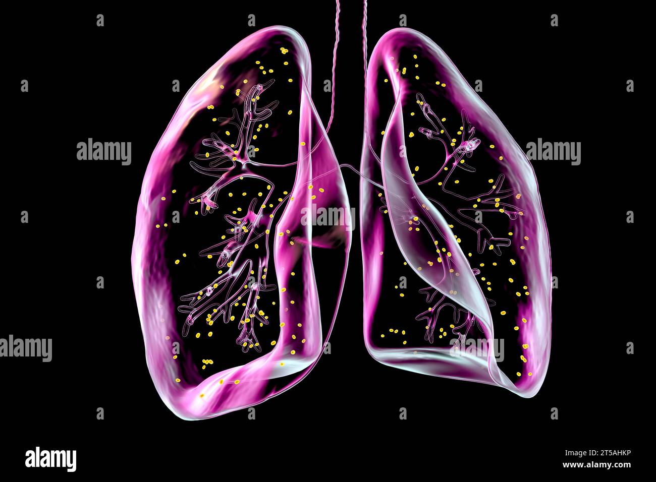 Lungenadiaspiromykose, Illustration Stockfoto