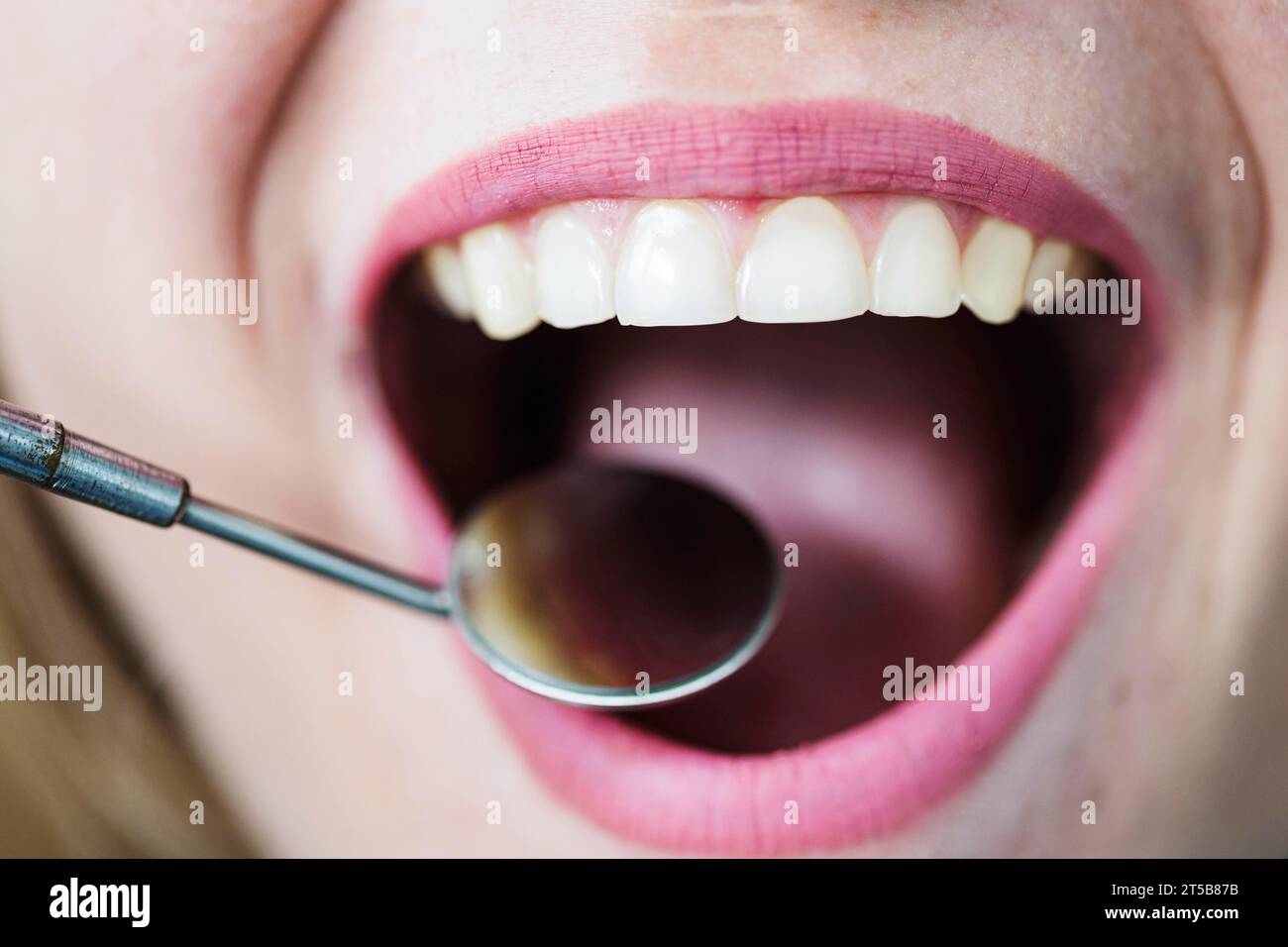 Frau mit offenem Mund und Zahnarztspiegel Stockfoto