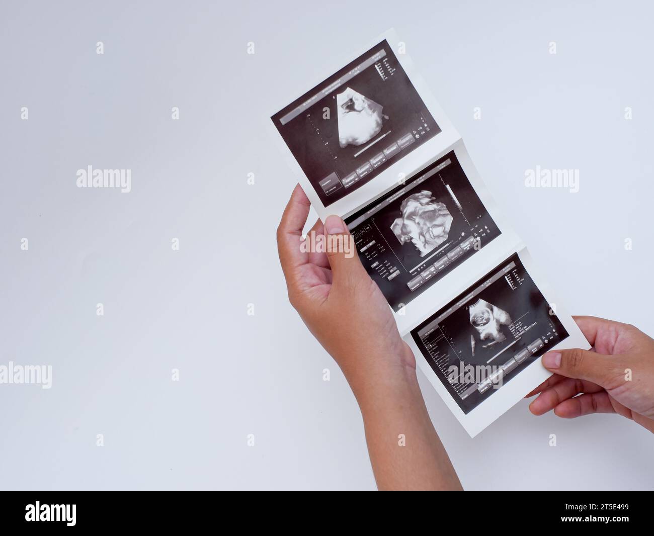Hand-Hold-Bild der Schwangerschaftssonographie isoliert auf weiß Stockfoto