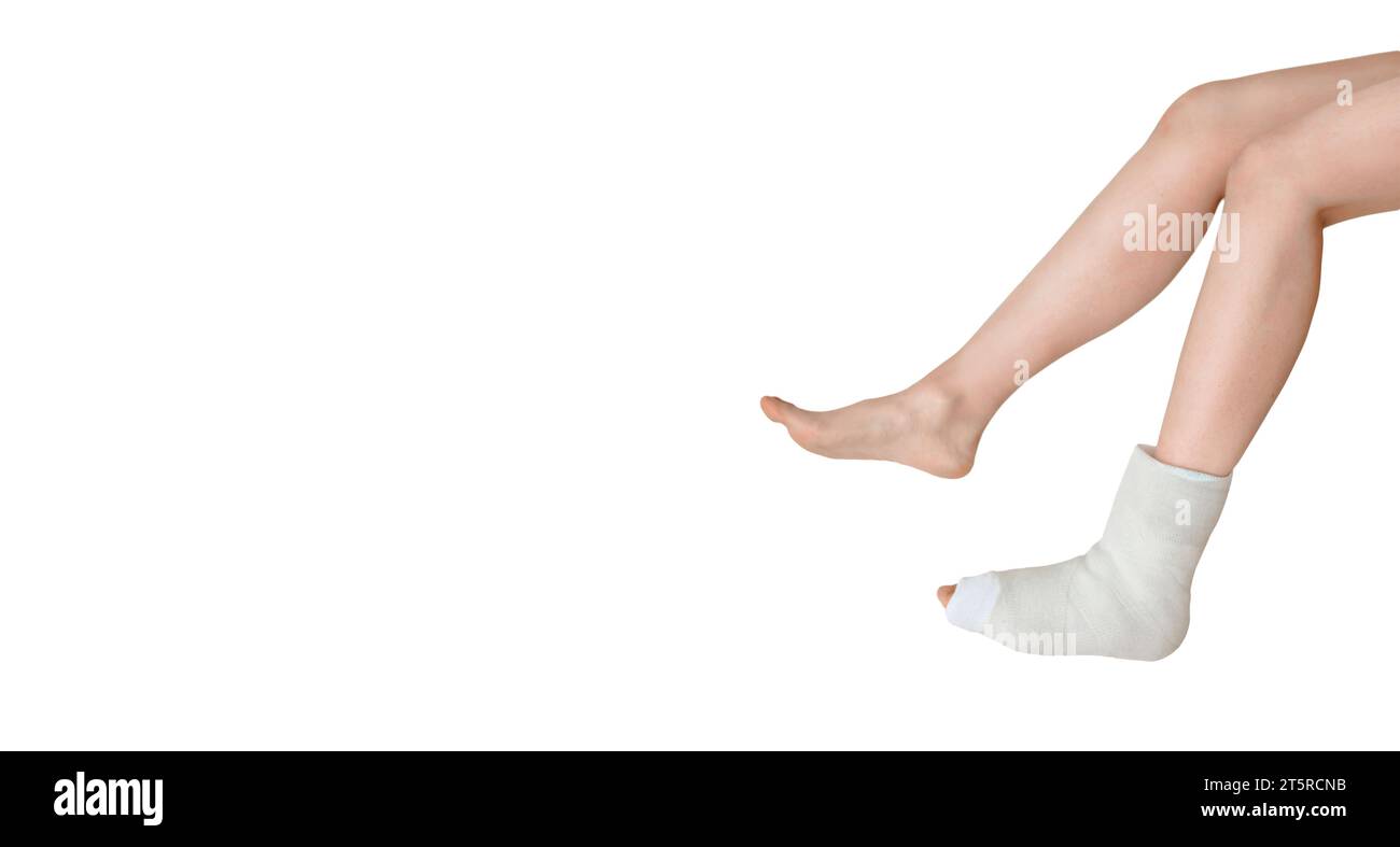 Gebrochenes Bein in einem Gips auf isoliertem weißem Hintergrund. Versicherungsvergütung. Rehabilitation nach schwerer körperlicher Unfallverletzung. Orthopädie Stockfoto