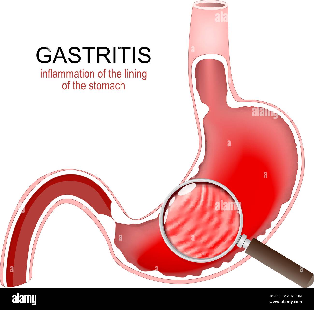 Gastritis. Magenentzündung. Gastrointestinale Störungen. Querschnitt eines menschlichen Magens und Entzündung der Magenschleimhaut Stock Vektor