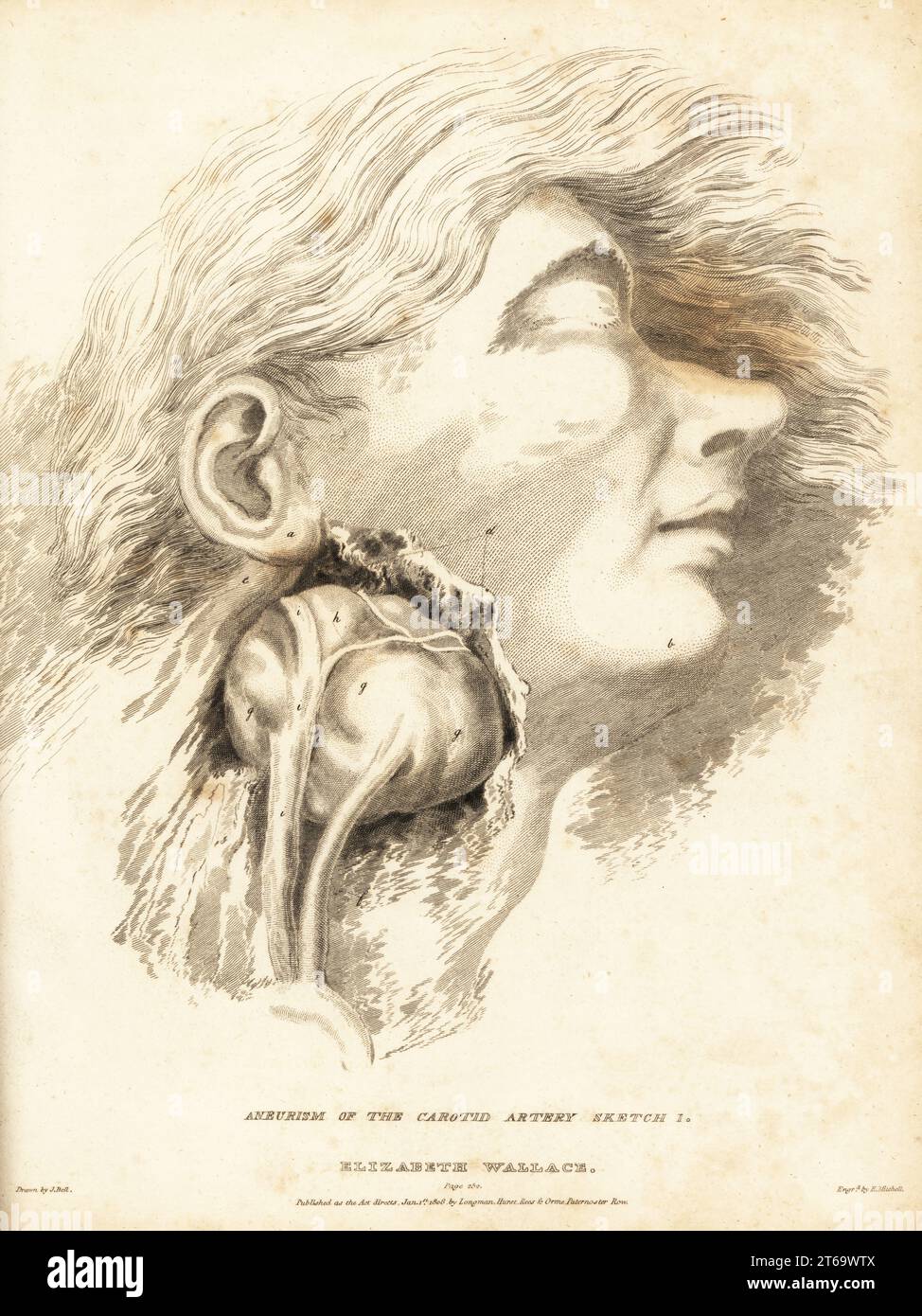 Dissektion eines tödlichen Tumors im Hals einer jungen Frau. Der schnell wachsende Krebs erstickte sie innerhalb eines Monats. Elizabeth Wallace, die 24-jährige Frau "Flesh cadie", eine Fleischporträterin auf einem Metzgermarkt. Aneurismus der A. carotis, Skizze 1. Kupferstich von Edward Mitchell nach einer Illustration von John Bell aus seinen eigenen Prinzipien der Chirurgie, wie sie sich auf Wunden, Ulzera und Fisteln beziehen, Longman, Hurst, Rees, Orme und Brown, London, 1815. Stockfoto