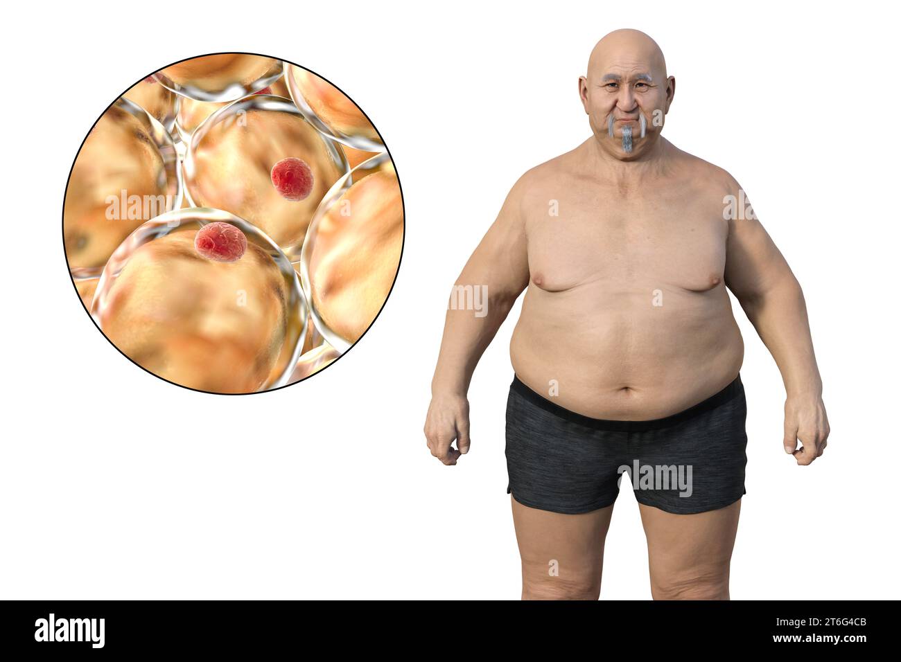 Eine medizinische 3D-Illustration, die einen übergewichtigen Mann mit einer Nahaufnahme der Adipozyten darstellt und die Rolle dieser Fettzellen bei Fettleibigkeit unterstreicht. Stockfoto