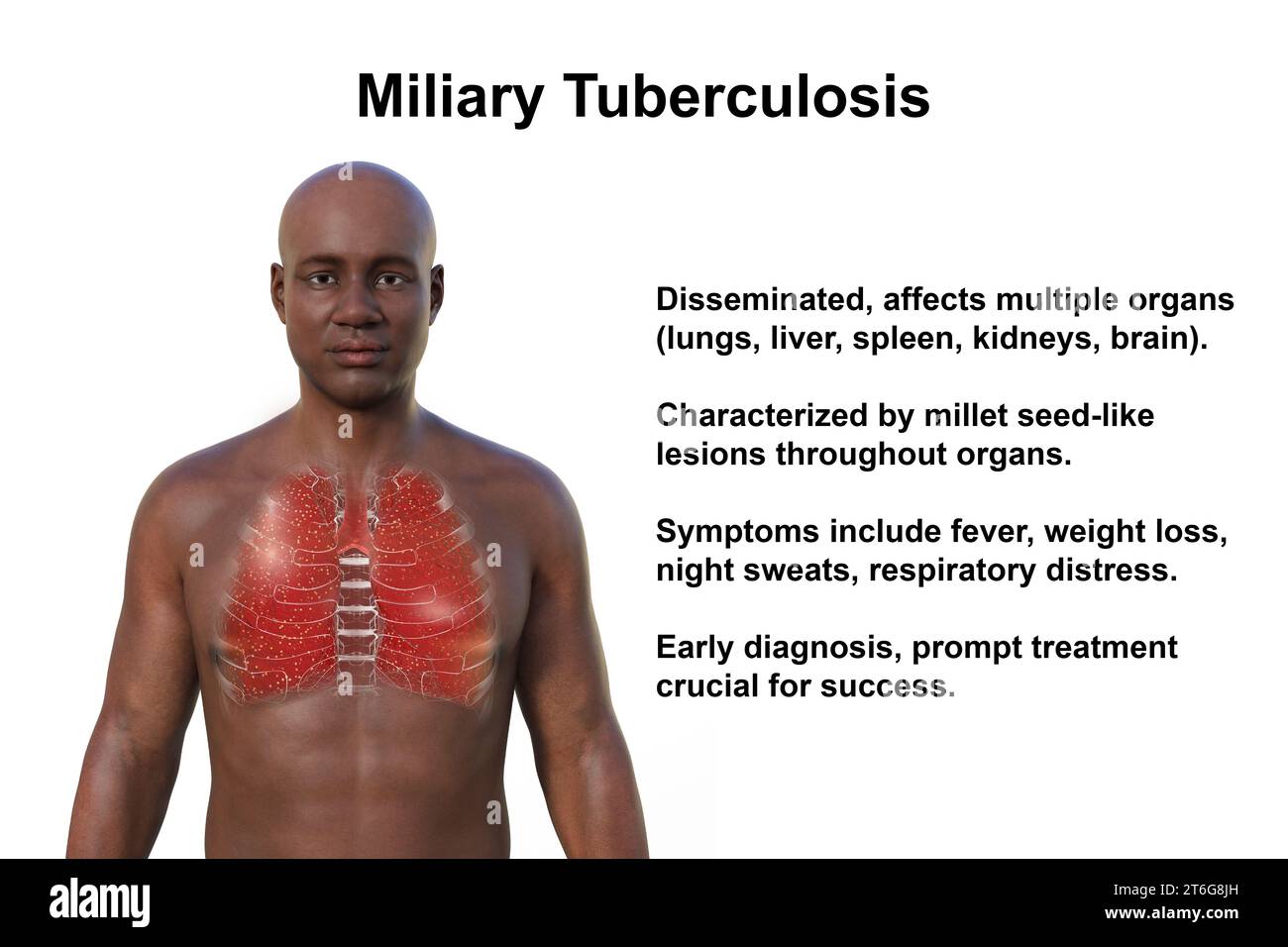 Eine fotorealistische 3D-Illustration der oberen Hälfte eines Mannes mit transparenter Haut, die die von Miliartuberkulose betroffene Lunge zeigt Stockfoto