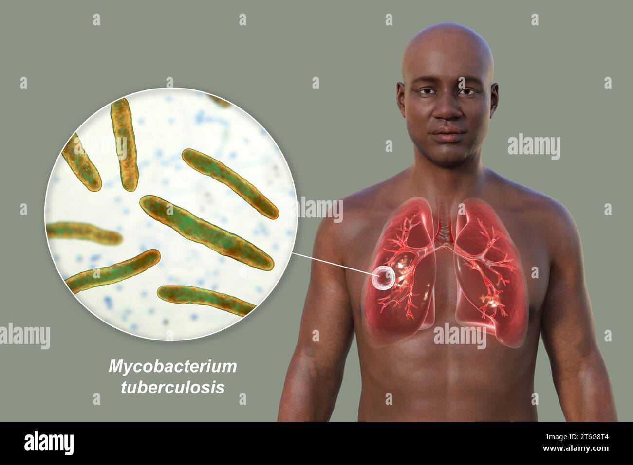 Eine fotorealistische 3D-Illustration der oberen Hälfte eines Mannes mit transparenter Haut, zeigt die Lungen, die von kavernöser Tuberkulose betroffen sind, und... Stockfoto