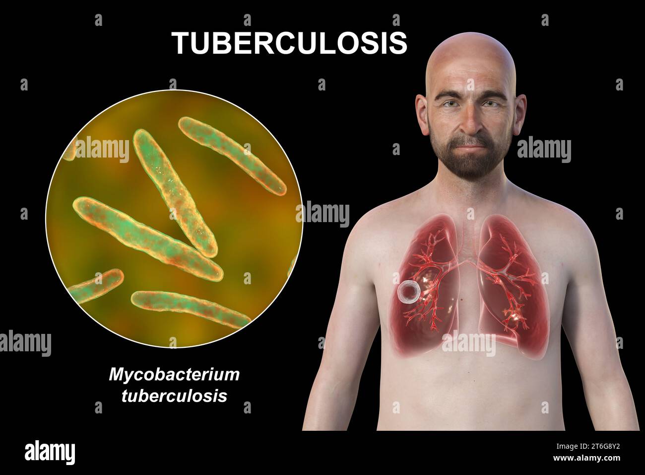 Eine fotorealistische 3D-Illustration der oberen Hälfte eines Mannes mit transparenter Haut, die die Lungen zeigt, die von kavernöser Tuberkulose und Close-u betroffen sind Stockfoto