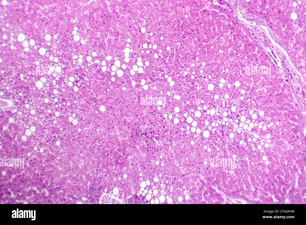 Photomikrograph der Lebersteatose, die Fettansammlung in Leberzellen, bekannt als Fettleberkrankheit, aufdeckt. Stockfoto
