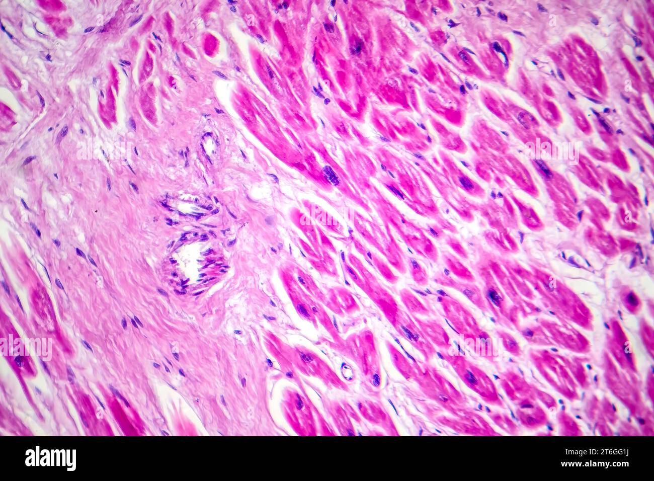 Photomikrographie des Myokardinfarkts, Darstellung von beschädigtem Herzgewebe durch verminderte Blutversorgung und Zelltod. Stockfoto
