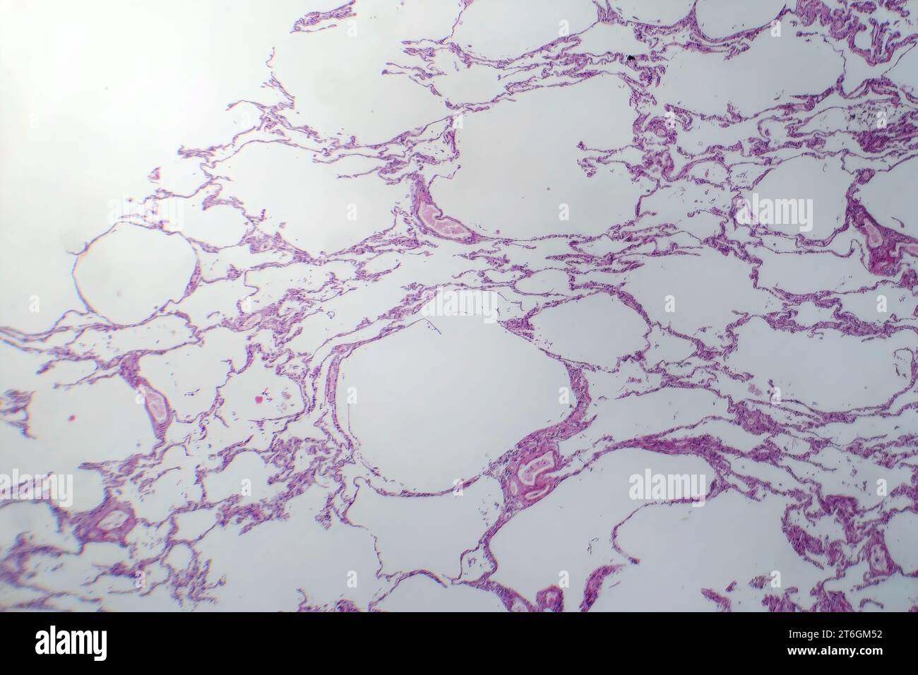 Photomikrographie des diffusen Emphysems, die bei chronisch obstruktiver Lungenerkrankung charakteristisch für das geschädigte Lungengewebe mit vergrößerten Lufträumen zeigt ( Stockfoto