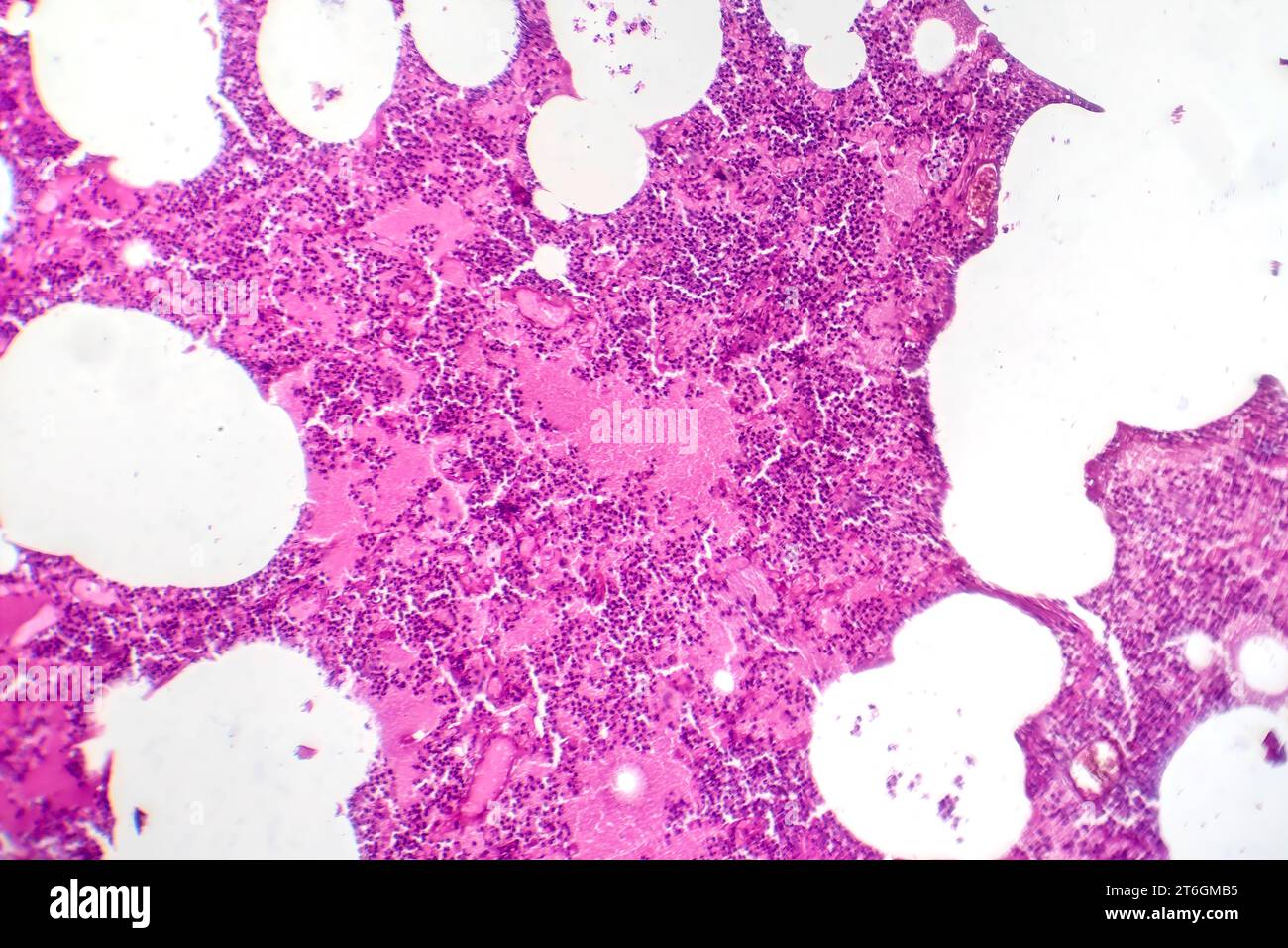 Photomikrographie der lobären Pneumonie während der hämorrhagischen Odemperiode, Darstellung der Lungengewebsentzündung mit hämorrhagischen Veränderungen. Stockfoto