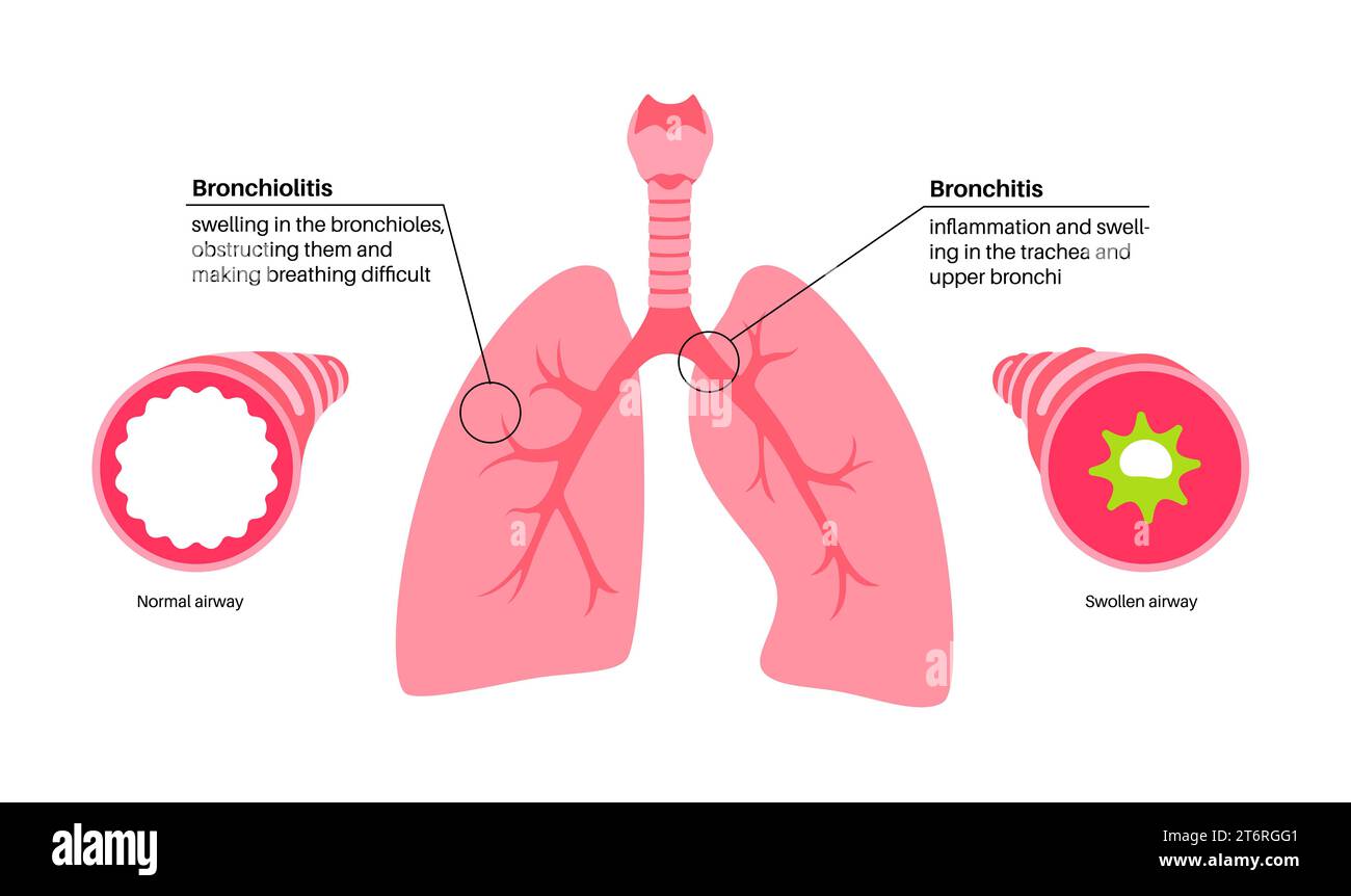Bronchitis und Bronchiolitis, Illustration Stockfotografie - Alamy