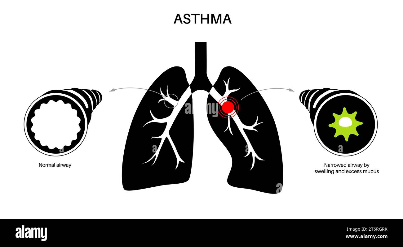 Asthma, Illustration Stockfoto