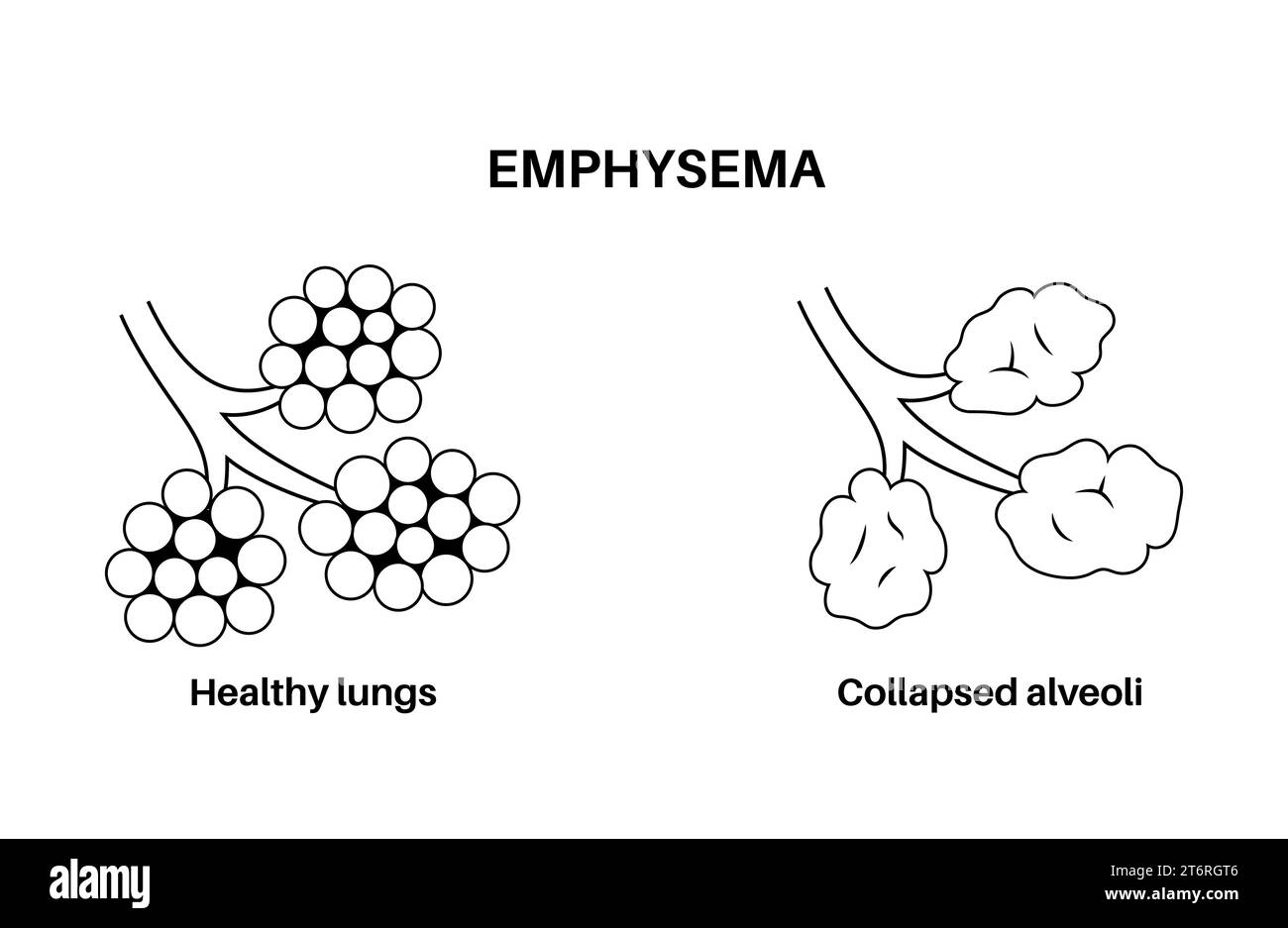 Emphysem, Illustration Stockfoto